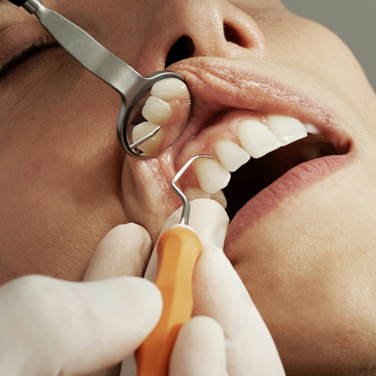 Restauração estética do sorriso — antes